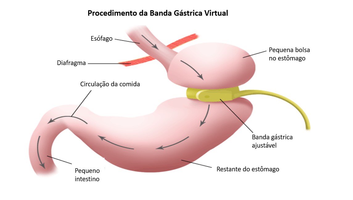 melaniegalant_hipnoterapia_bandagastricavirtual